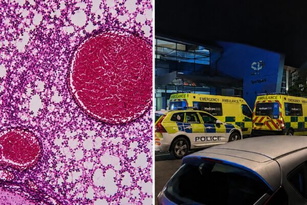 Meningitis outbreak sparks alarm after student dies and 2 others